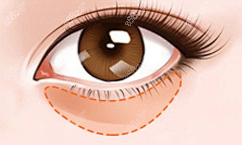 眼袋位置及顏色展示