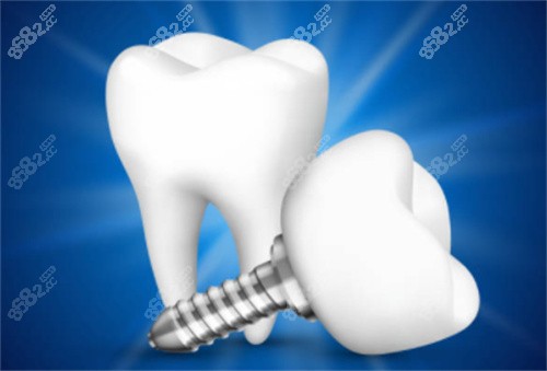 2顆種植牙模型圖