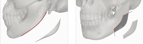 下頜角手術(shù)
