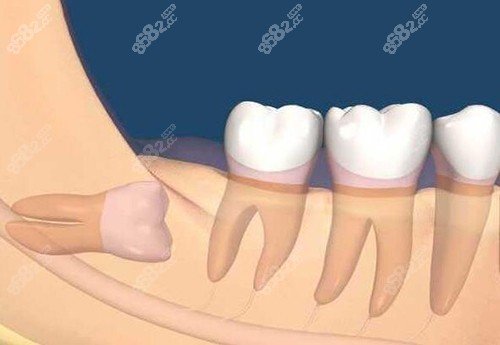 牙齒阻生智齒卡通圖
