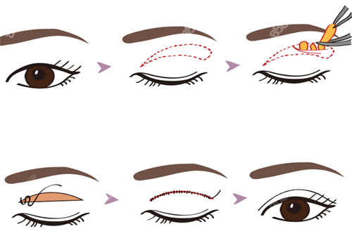 雙眼皮手術(shù)展示