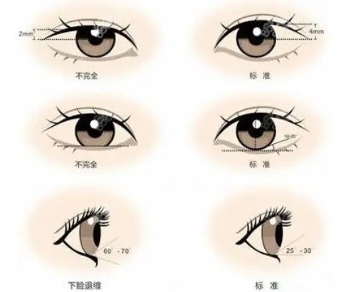 雙眼皮對(duì)比圖