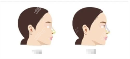 長沙隆鼻需要多少錢？雅美做鼻子貴不貴？價格、醫(yī)生、材料一次說清