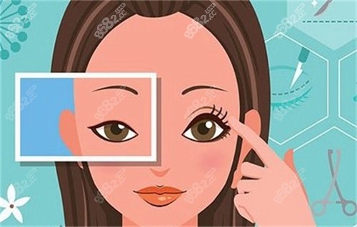 雙眼皮手術(shù)前后對(duì)比