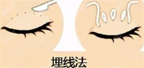 雙眼皮埋線怎么做的
