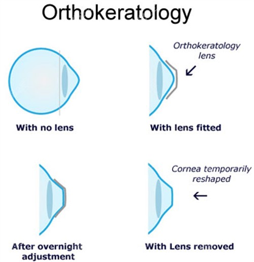 角膜塑形鏡佩戴前后對比