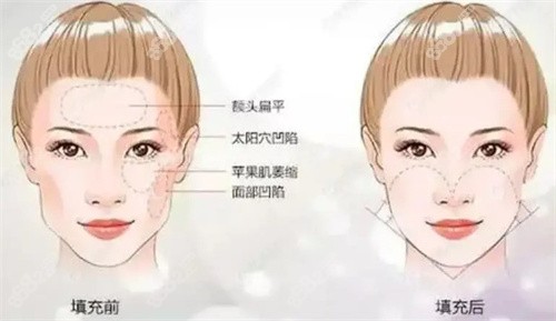 面頰填充術(shù)前后對比