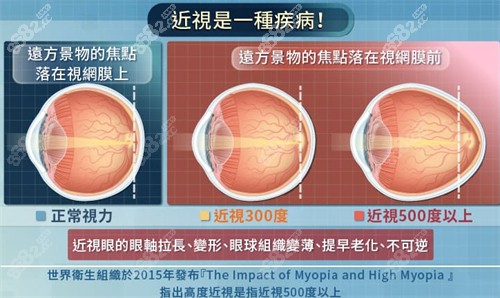 不同程度近視的眼球變化圖解
