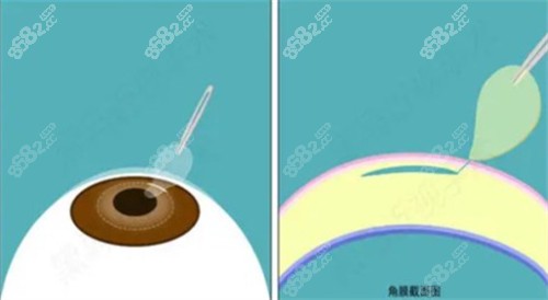 激光近視手術(shù)過程圖解