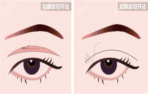 全切雙眼皮手術(shù)的切口部位