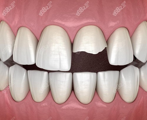 牙齒缺損圖