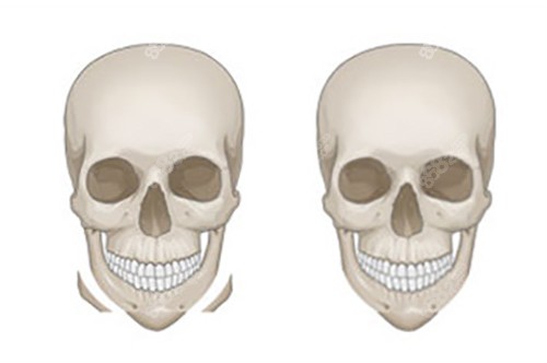 下頜削骨示意圖