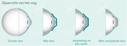 角膜塑形鏡改善圓錐角膜