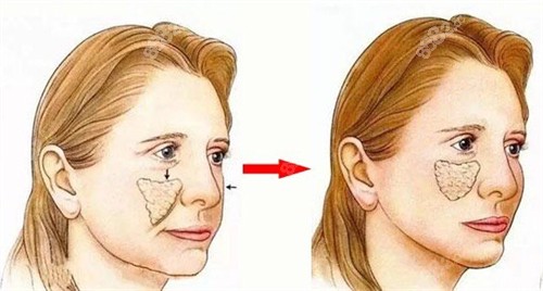 蘋果肌下垂術(shù)前術(shù)后對比動畫圖