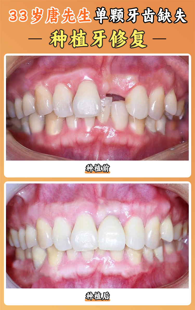 銅川博德口腔醫(yī)院種牙怎么樣？2980元起即拔即種，服務(wù)好性價(jià)比超高