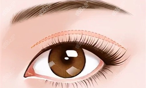 西安雙眼皮醫(yī)院哪家好？國醫(yī)、藝星、葉子、美萊等實(shí)力機(jī)構(gòu)PK