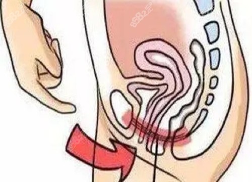 女性私密整形位置示意圖