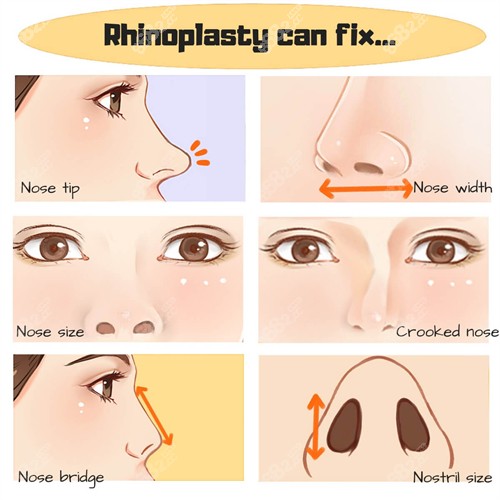 鼻修復(fù)流程一覽圖