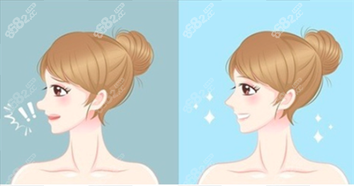 鼻修復(fù)對(duì)比