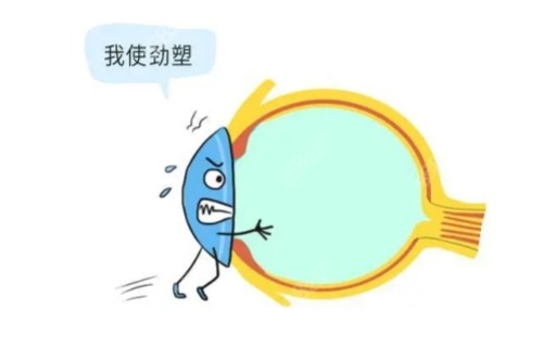 角膜塑形鏡卡通概念圖