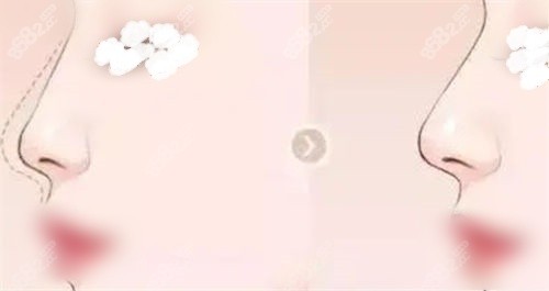 隆鼻鼻部鼻梁術(shù)前術(shù)后展示圖