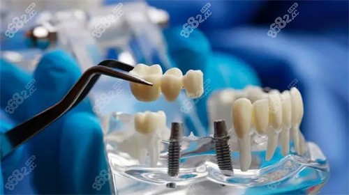 種植牙植體和牙冠安裝模型示意圖