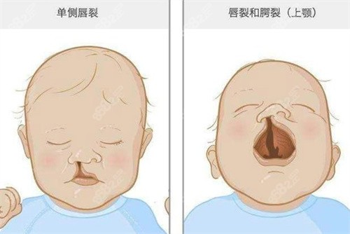 晉曉菊做輕微唇裂怎么樣？多層減張縫合及鼻底支撐調(diào)整，3個月修復(fù)期對比