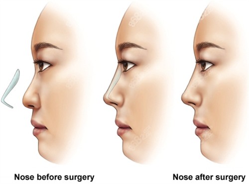 假體隆鼻手術(shù)前后對(duì)比