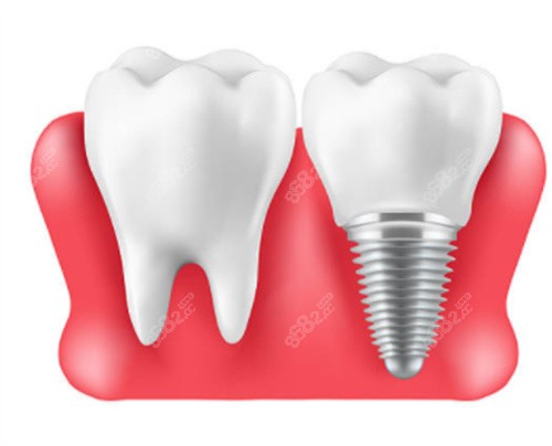 自然牙和種植牙