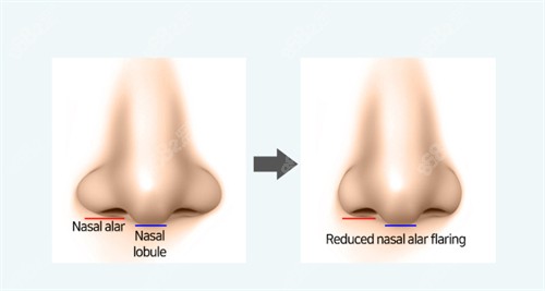 鼻翼縮小的對(duì)比圖
