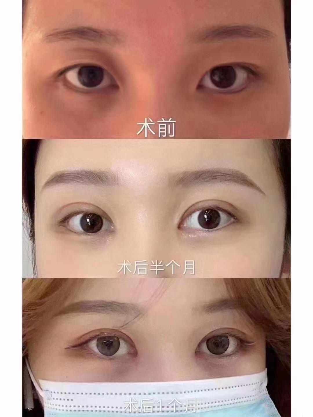 合肥曹林和杜园园谁更适合眼部整形？曹林风格自然成功率高，杜园园学术成就高 