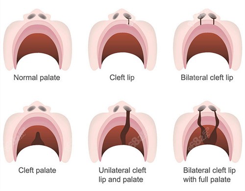 唇裂修復(fù)類型