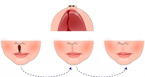 唇裂修復(fù)過程