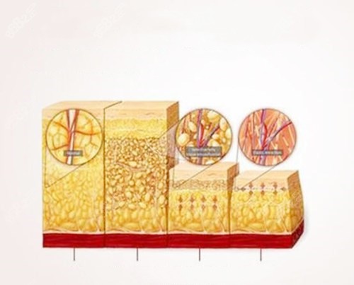 吸脂卡通圖展示