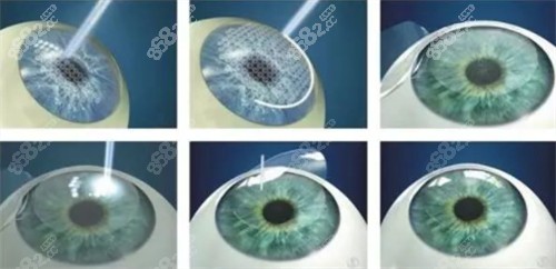 全飛秒近視手術(shù)過(guò)程詳細(xì)圖解
