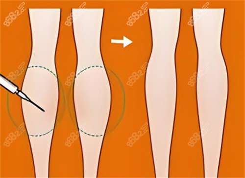 小腿吸脂前后對比