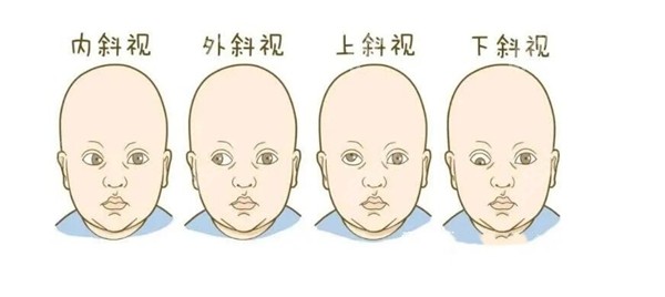 蘭大二院眼科斜視手術(shù)費(fèi)多少