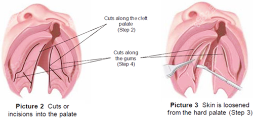 唇裂修復(fù)圖片一覽