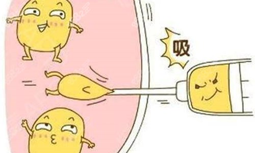 吸脂手術示意圖