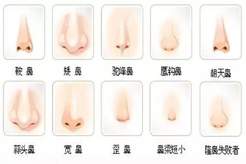 不美觀鼻型示意圖