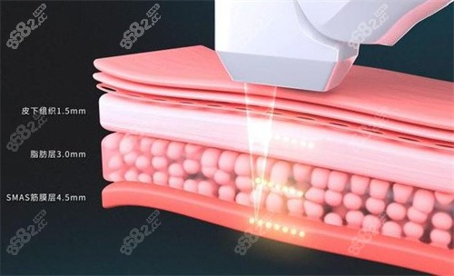 超聲炮治療深度