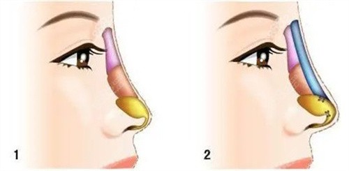 不同材料隆鼻對比