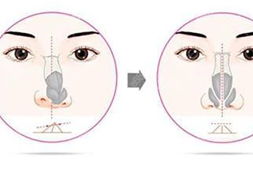 鼻矯正示意圖