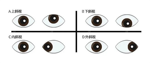 蘭大二院眼科斜視手術(shù)費(fèi)多少