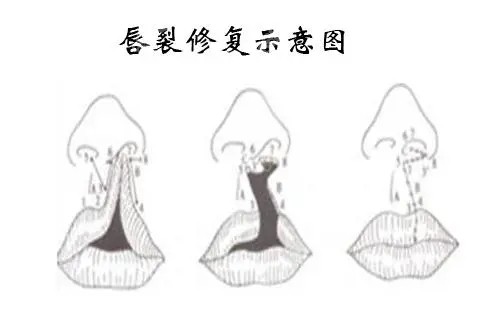 唇裂修復(fù)示意圖.webp
