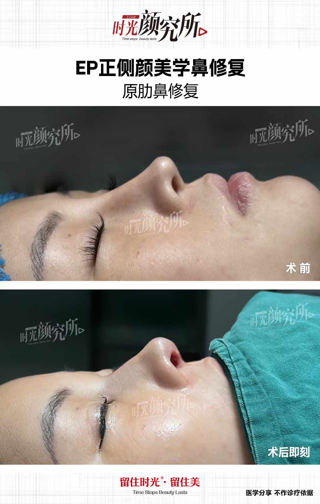 華 西醫(yī)院卿勇做鼻子：面診與實(shí)操攻略