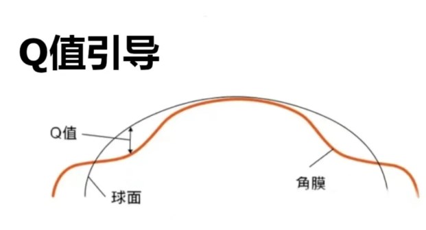 成都愛迪眼科做近視眼手術(shù)咋樣？患者術(shù)后反饋良好