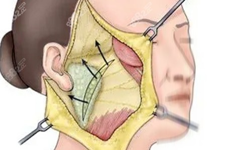 拉皮手術(shù)剖開動(dòng)畫示意圖