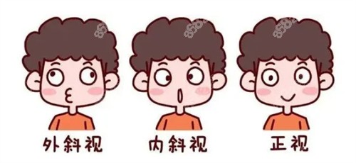 外斜內(nèi)斜和正常眼睛的對比圖