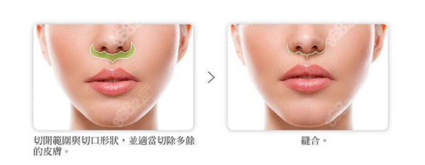 北京王曉健人中縮短多少錢 北京王曉健人中縮短多少錢